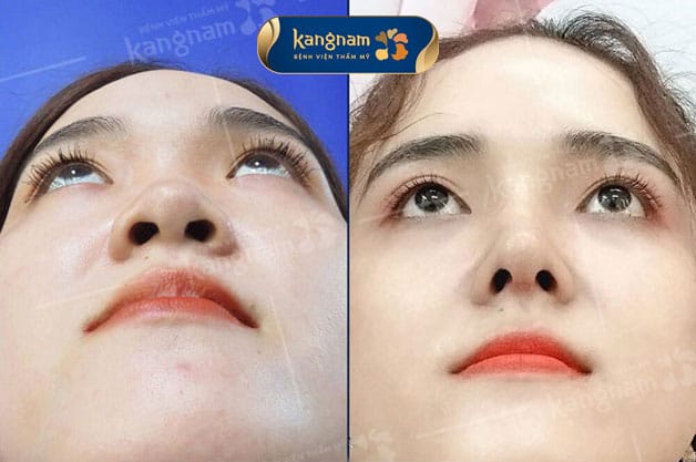 Cắt cánh mũi bao lâu thì lành? Gallery 1