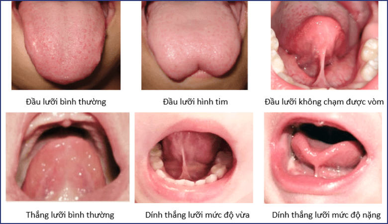 Cắt thắng lưỡi bao lâu lành? Gallery 1