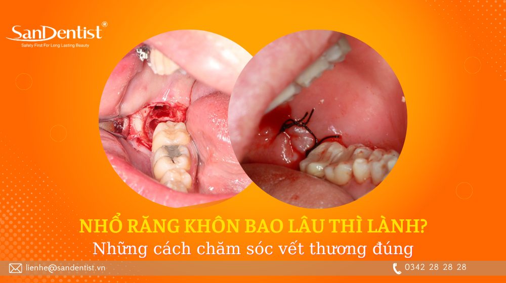 Nhổ răng số 7 bao lâu thì lành? Gallery 1
