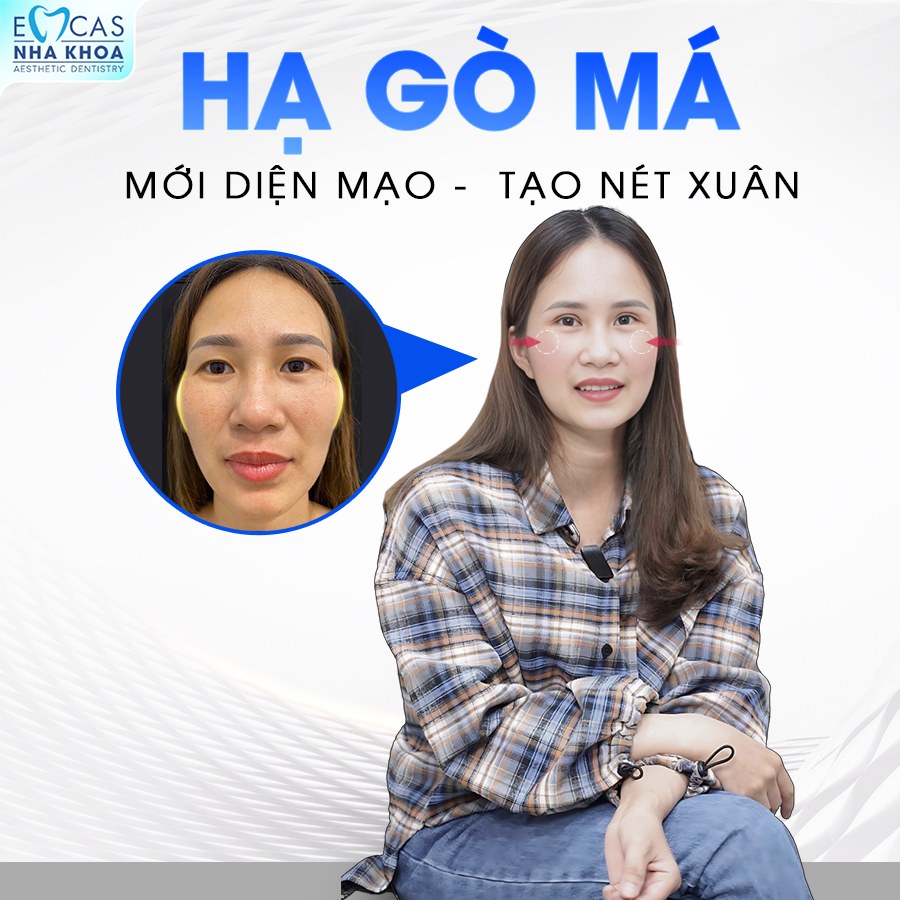Hạ gò má bao lâu thì lành? Gallery 1