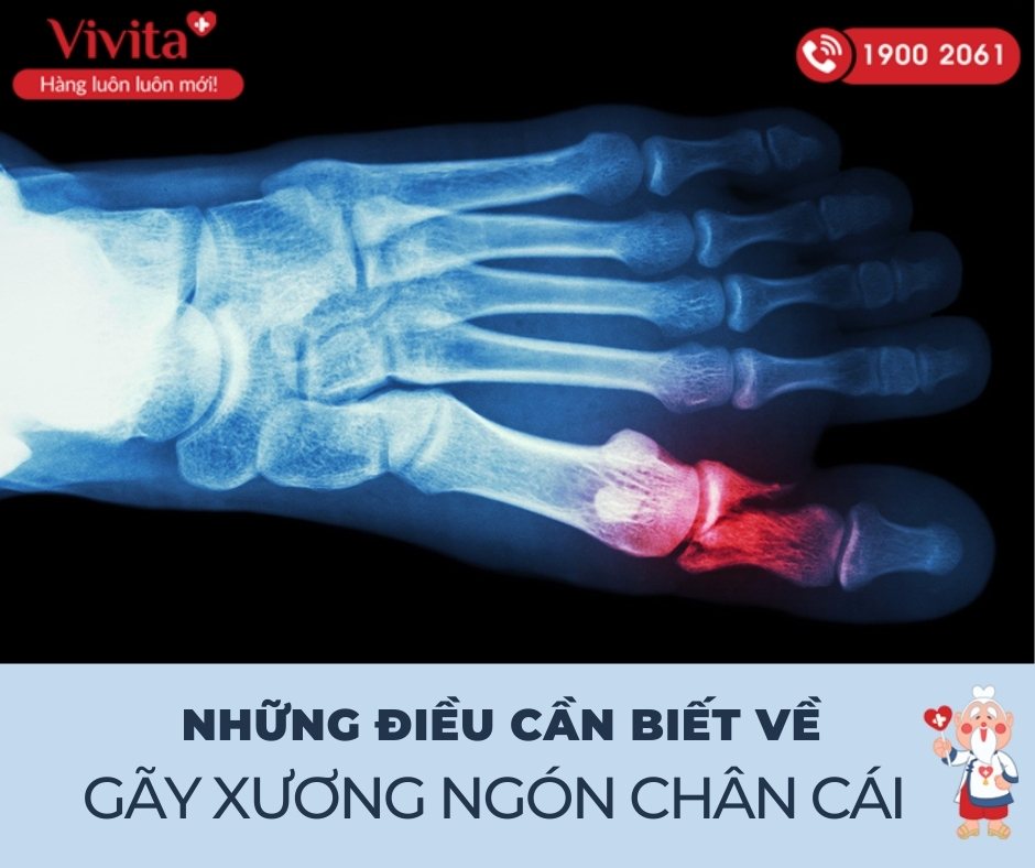 Gãy xương ngón chân cái bao lâu thì lành? Gallery 1