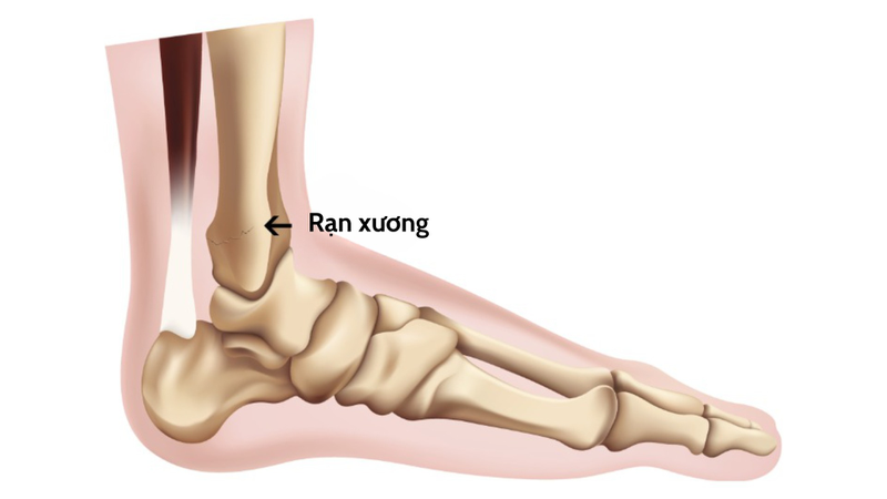 Rạn xương bàn chân bao lâu thì khỏi? Gallery 1