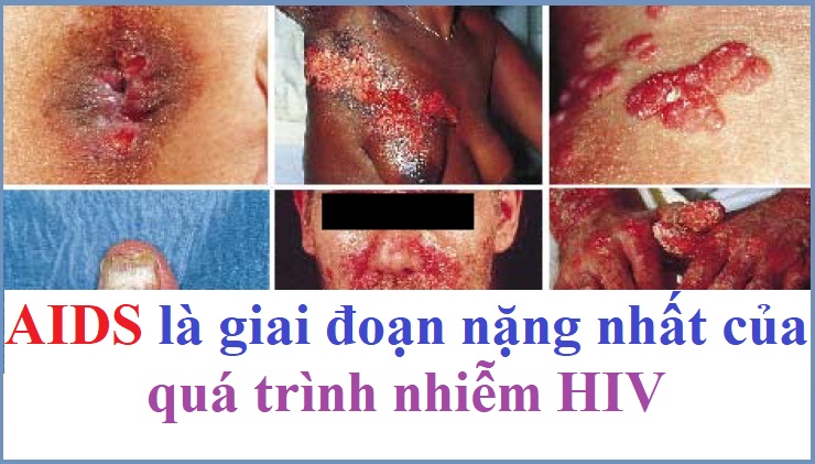 AIDS Giai Đoạn Cuối Sống Được Bao Lâu? Gallery 1
