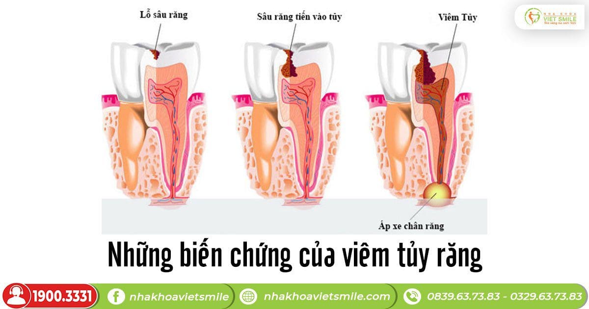 Bị Viêm Tụy Sống Được Bao Lâu? Gallery 1