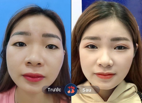 Cắt môi trái tim có được vĩnh viễn không? Gallery 2