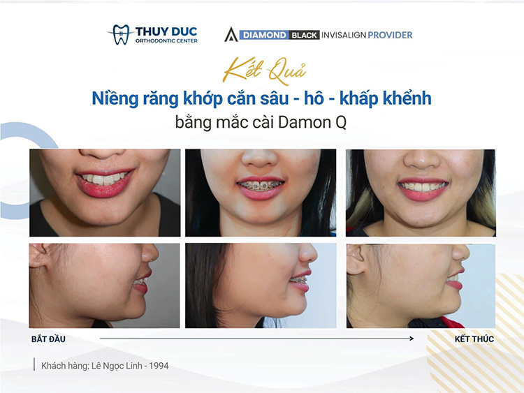 Hàm Răng Chuẩn Nhìn Nghiêng Gallery 2