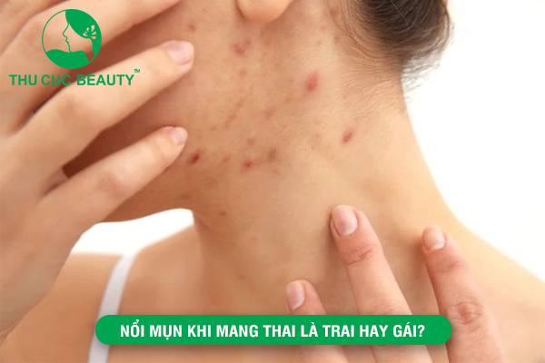 Nổi Mụn Khi Mang Thai Là Trai Hay Gái? Gallery 2