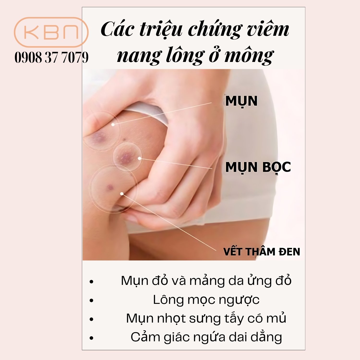 Mọc lông ở mông: Nguyên nhân, cách chăm sóc và điều trị Gallery 2
