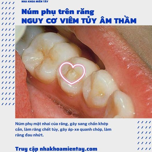 Núm Phụ Mặt Nhai Gallery 2