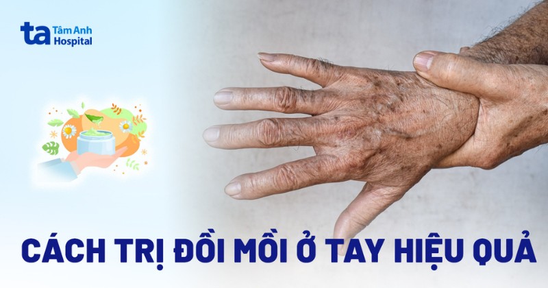 Cách Chữa Đồi Mồi Ở Tay Hiệu Quả Gallery 2