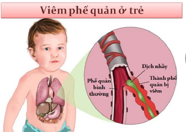 Cách Chữa Dứt Điểm Viêm Phế Quản Ở Trẻ Em