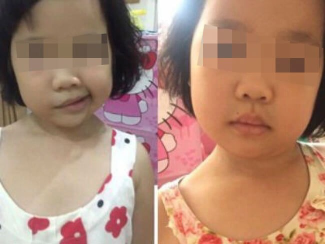 Cách Chữa Méo Miệng Ở Trẻ Em