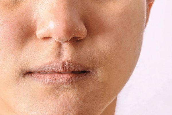 Cách Chữa Nẻ Mặt Hiệu Quả