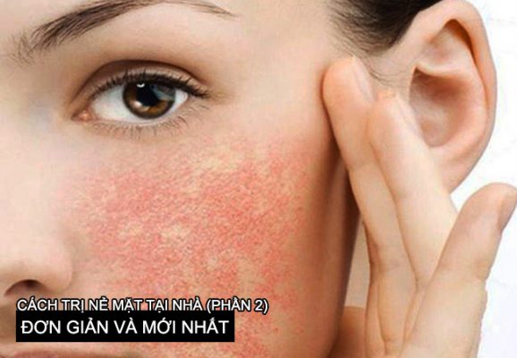 Cách Chữa Nẻ Mặt Hiệu Quả Gallery 2