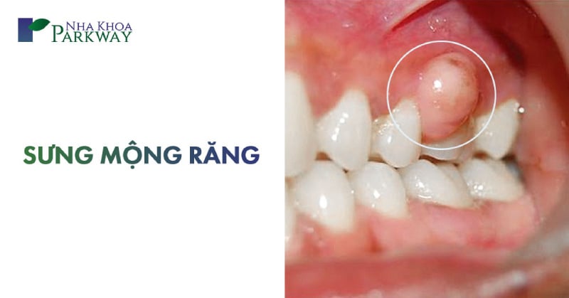 Cách Chữa Sưng Mộng Răng Hiệu Quả