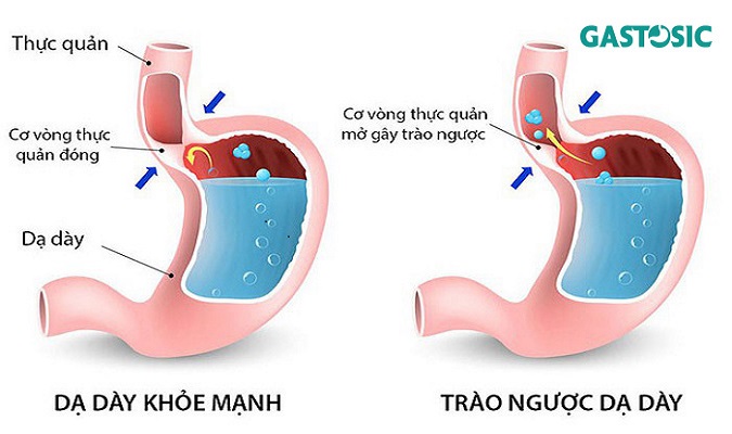 Cách Chữa Xót Ruột Hiệu Quả Và An Toàn Gallery 2