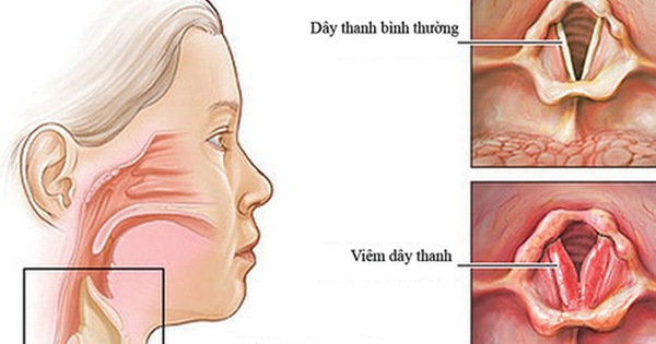Cách Để Giọng Hết Khàn