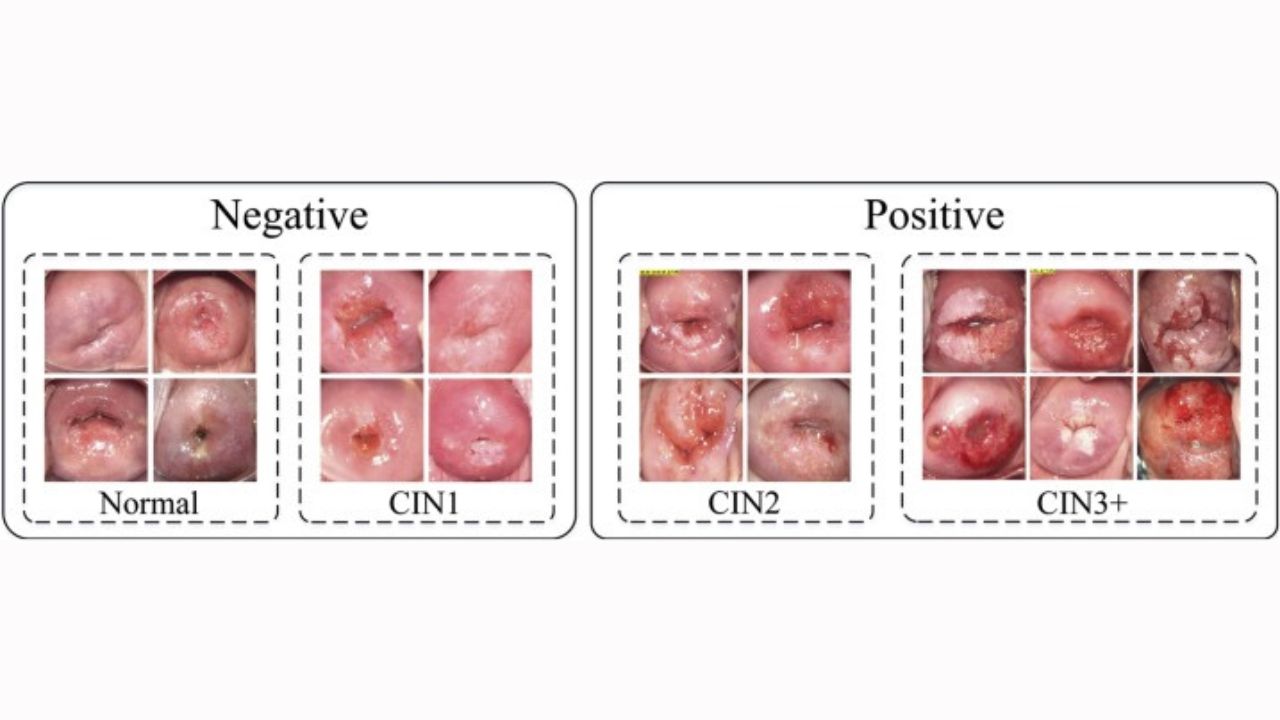 Cách Điều Trị CIN 3