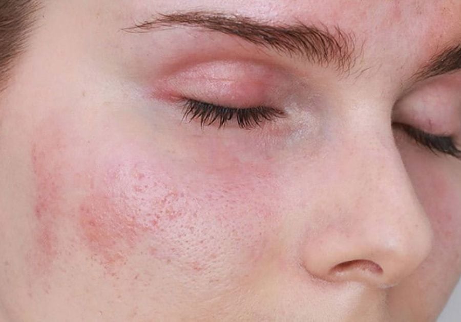 Da mặt bị ngứa nổi mẩn đỏ: Nguyên nhân và cách điều trị hiệu quả Gallery 2