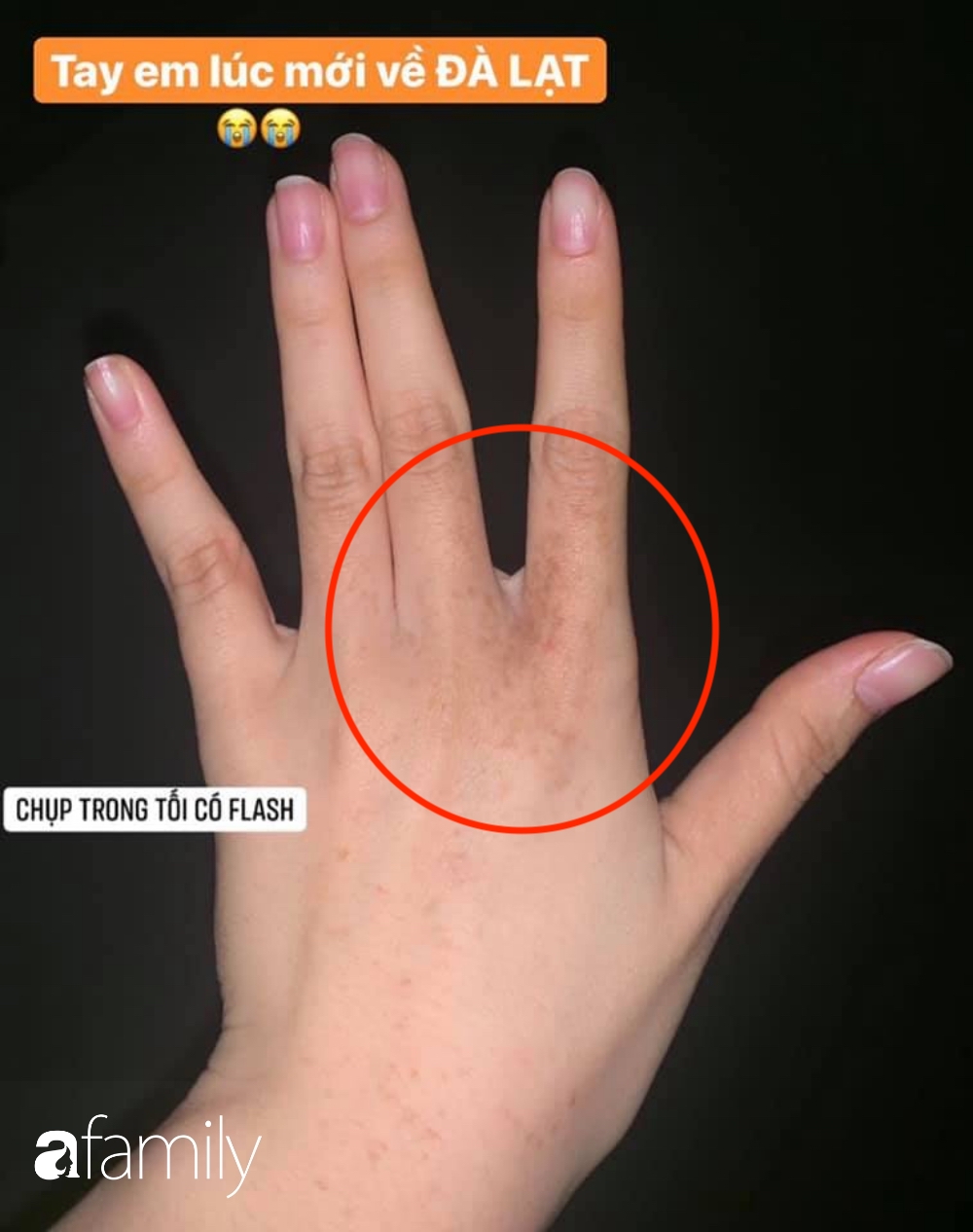 Mu Bàn Tay Nổi Đốm Nâu: Nguyên Nhân Và Cách Điều Trị Gallery 2