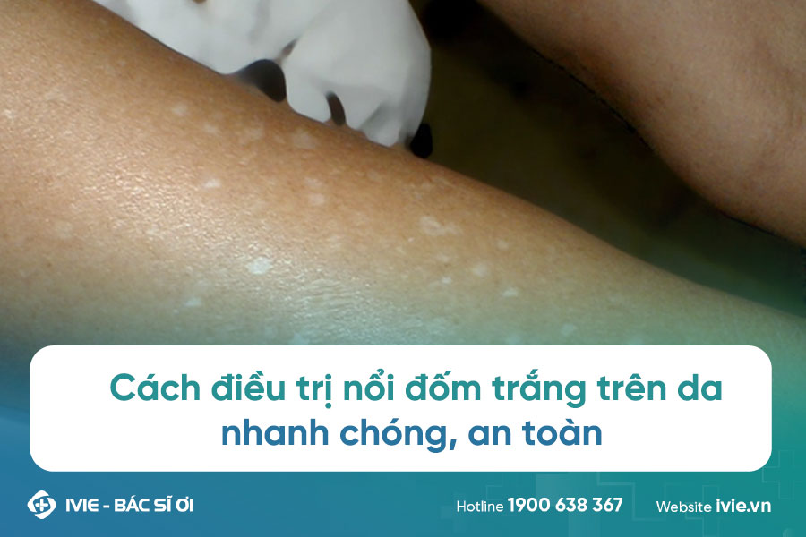 Da có đốm trắng là gì và cách điều trị hiệu quả Gallery 2