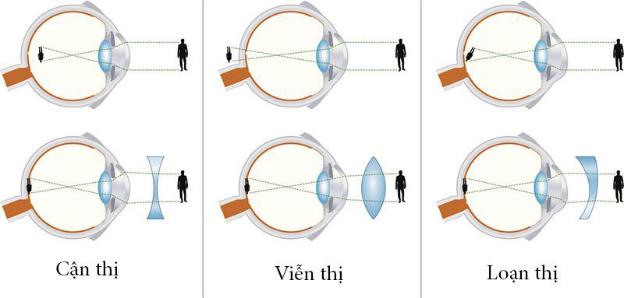 Khúc Mắt Là Gì? Nguyên Nhân Và Cách Điều Trị Gallery 2