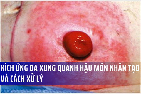 Cách Trị Loét Da Xung Quanh Hậu Môn Nhân Tạo Gallery 2