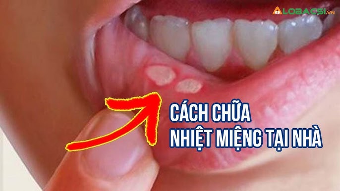 Lốt ăng giơ lét là gì? Gallery 2