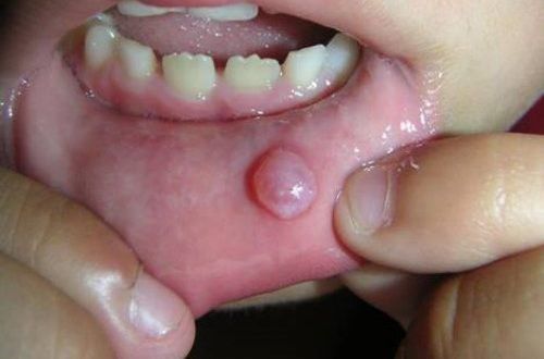 Môi Bị Nổi Bọng Nước: Nguyên Nhân, Cách Điều Trị Và Phòng Ngừa Gallery 2