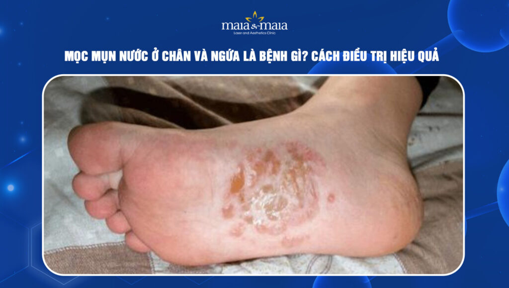 Nổi Bọng Nước Ở Chân: Nguyên Nhân, Cách Điều Trị Và Phòng Ngừa Gallery 2