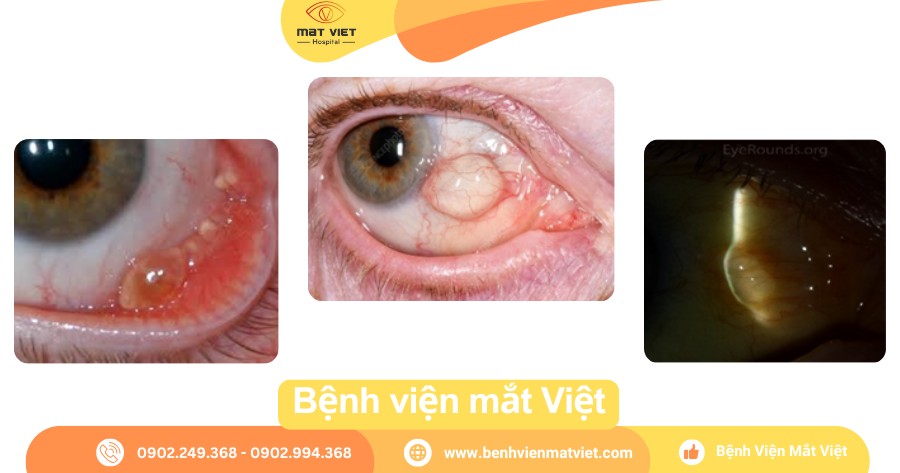 Nổi Bọng Nước Trong Mắt Gallery 2