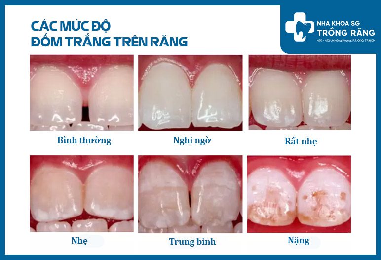 Răng có vệt trắng là gì? Nguyên nhân và cách khắc phục Gallery 2