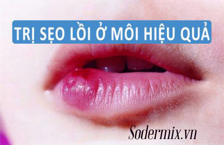 Sẹo Lồi Ở Môi: Nguyên Nhân, Điều Trị Và Phòng Ngừa Gallery 2
