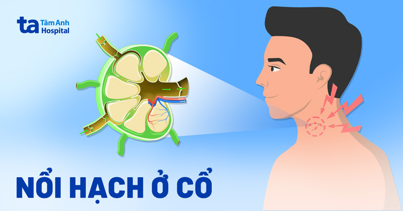Trái Khế Ở Cổ Là Gì? Nguyên Nhân Và Cách Điều Trị Gallery 2