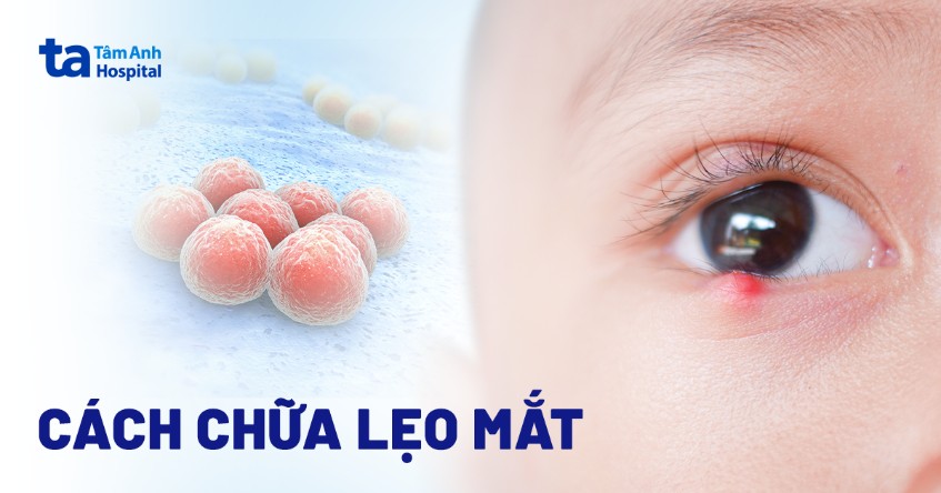 Trẹo Lẹo Là Gì? Nguyên Nhân, Cách Điều Trị Và Phòng Ngừa Gallery 2