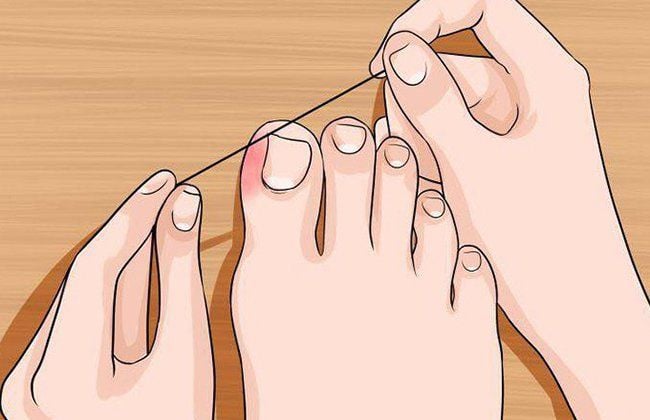 Cách Giảm Đau Khóe Chân