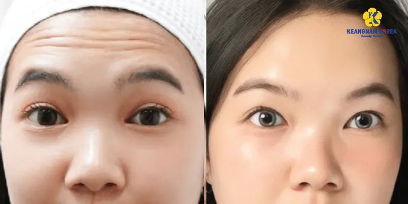 Trán Có 3 Nếp Nhăn Ngang: Nguyên Nhân Và Cách Khắc Phục Gallery 2