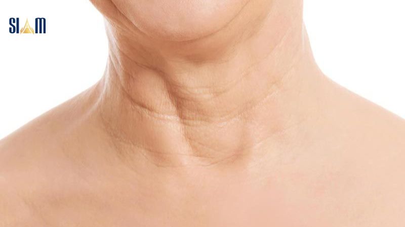Cổ Có Nhiều Ngấn: Nguyên Nhân, Cách Khắc Phục và Phòng Ngừa Gallery 2