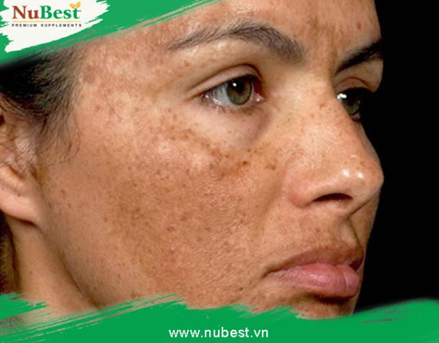 Da Trán Bị Sạm Đen: Nguyên Nhân và Cách Khắc Phục Hiệu Quả Gallery 2