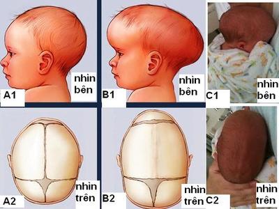 Đỉnh Đầu Nhô Cao: Nguyên Nhân và Cách Khắc Phục Gallery 2