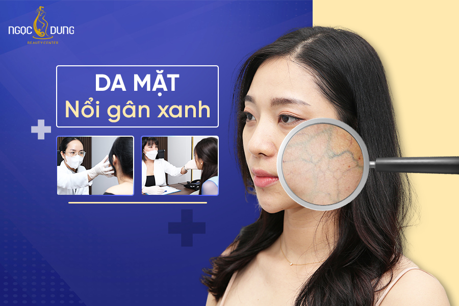 Gân Nổi Trên Trán: Nguyên Nhân Và Cách Khắc Phục Gallery 2