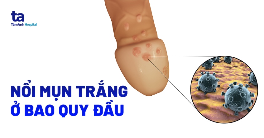 Chim Mọc Mụn Trắng: Nguyên Nhân và Cách Khắc Phục Gallery 2