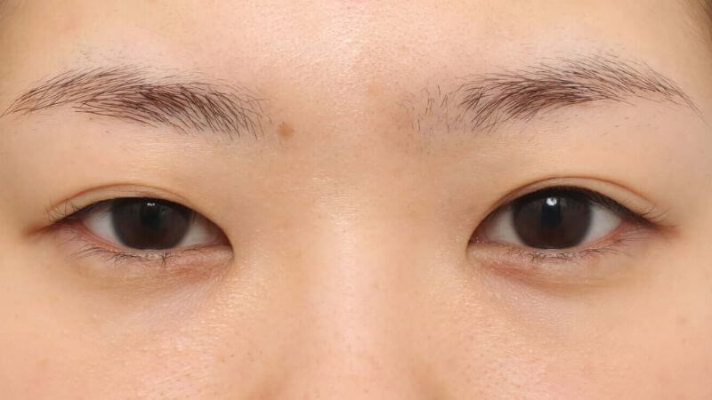 Khuất Mắt Là Gì? Gallery 2
