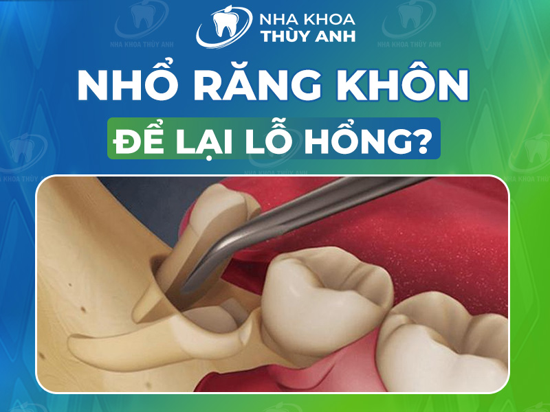 Lỗ Hổng Là Gì? Định Nghĩa, Phân Loại Và Cách Khắc Phục Gallery 2