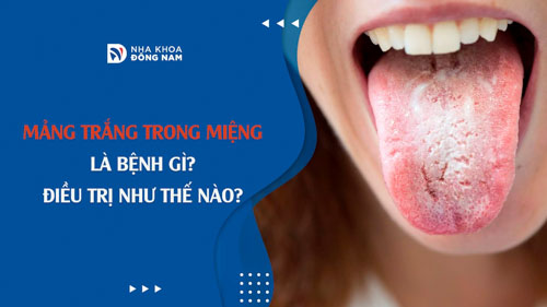 Mảng trắng trong miệng sau khi đánh răng: Nguyên nhân và cách khắc phục Gallery 2