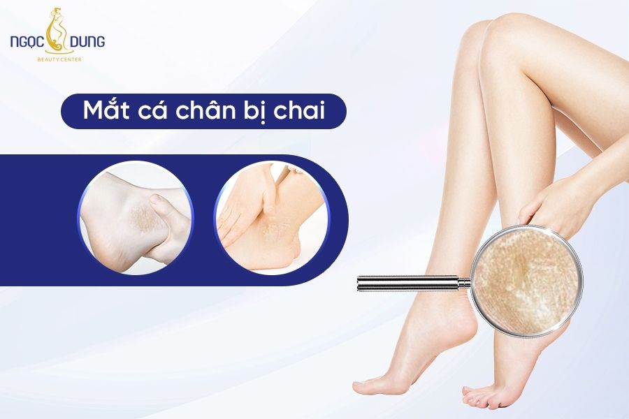 Mắt Cá Chân Bị Chai Thâm: Nguyên Nhân và Cách Khắc Phục Gallery 2