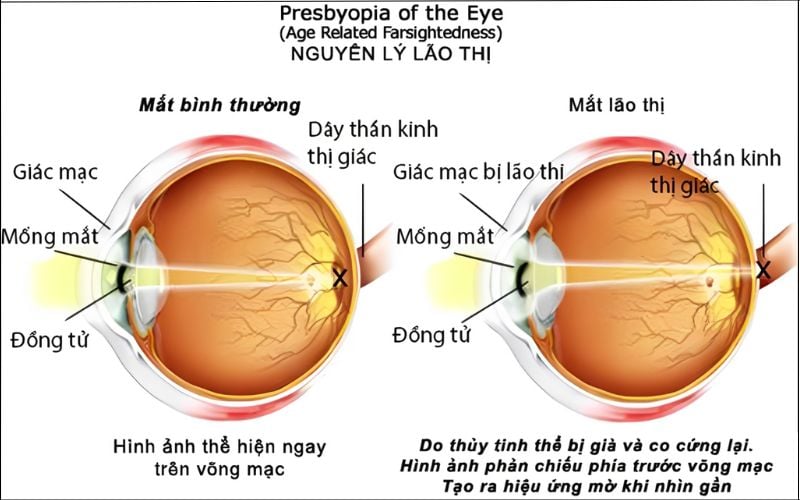 Mắt lão là mắt gì? Gallery 2