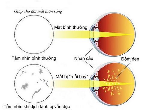Mắt Nhìn Thấy Ruồi Bay: Nguyên Nhân Và Cách Khắc Phục Gallery 2