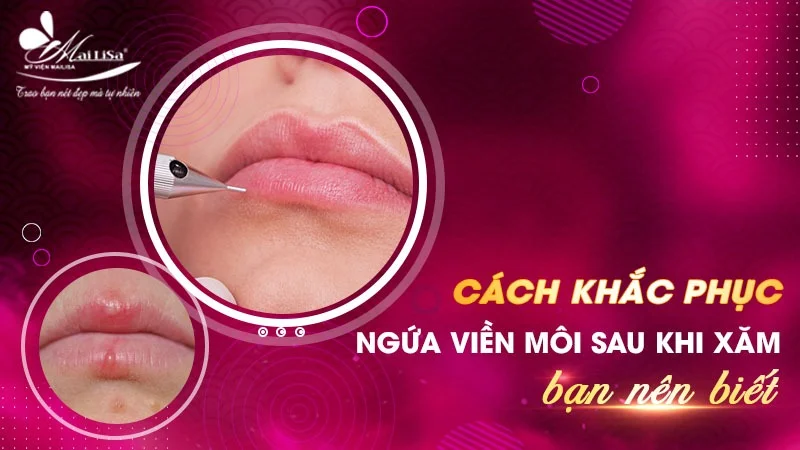 Môi Bong Sau Phun Bị Ngứa: Nguyên Nhân và Cách Khắc Phục Gallery 2
