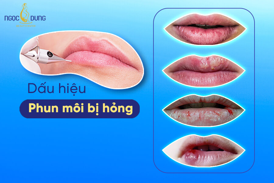 Môi Bong Tróc Sậm Màu: Nguyên Nhân và Cách Khắc Phục Gallery 2